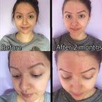 3-Step Acne System